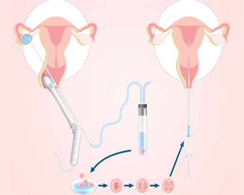 成都助孕供卵,试管移植当天注意什么-医院四维彩超什么标记是女孩-成都华西医